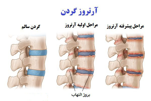 مهره های گردنی