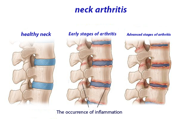Cervical vertebrae